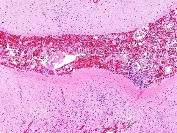 3B2 Rasmussen Encephalitis (Case 3) H&E 9