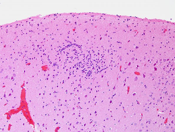 3B3 Rasmussen Encephalitis (Case 3) H&E 2