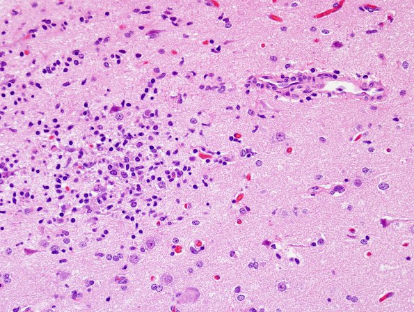 3B4 Rasmussen Encephalitis (Case 3) H&E 13