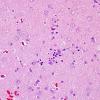 3B5 Rasmussen Encephalitis (Case 3) H&E 3