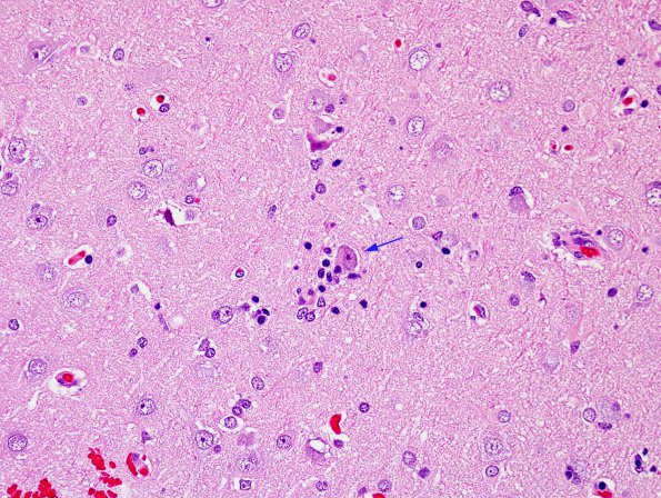 3B5 Rasmussen Encephalitis (Case 3) H&E 3