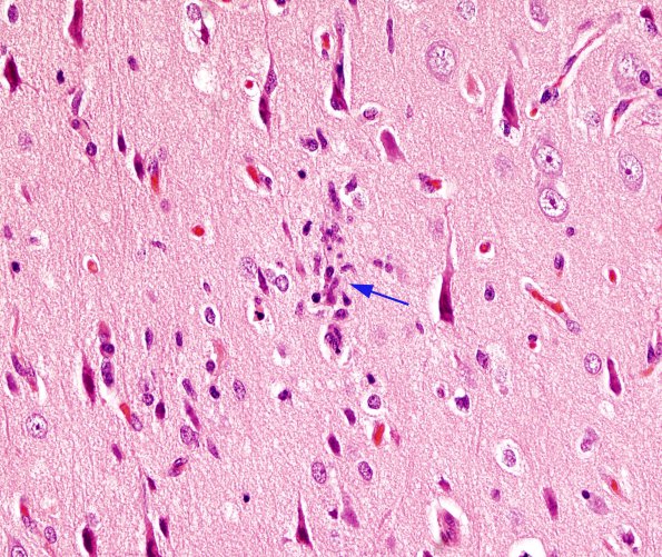 4 Rasmussens Chronic Enceph (Case 4) H&E 5