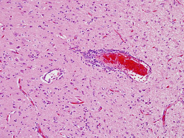 5 Rasmussens Chronic Encephalitis (Case 5) H&E 2