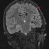 6A1 Rasmussen's Encephalitis (Case 6) T2 BLADE FLAIR COR - Copy