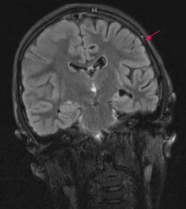 6A1 Rasmussen's Encephalitis (Case 6) T2 BLADE FLAIR COR - Copy