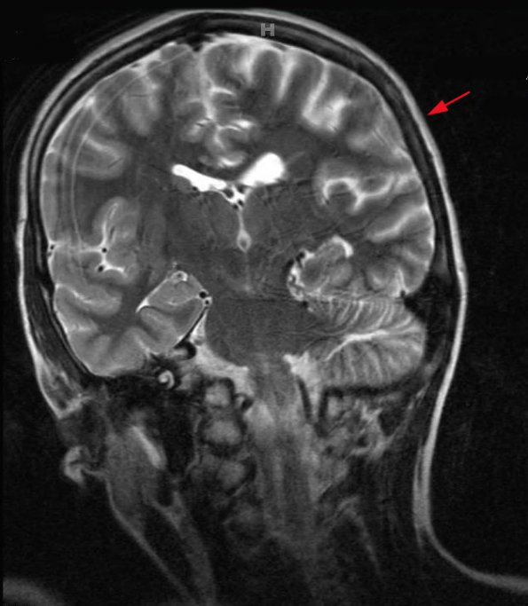 6A2 Rasmussen's Encephalitis (Case 6) T2 TSE COR 512 3mm - Copy