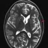 6A3 Rasmussen's Encephalitis (Case 6) T2 - Copy