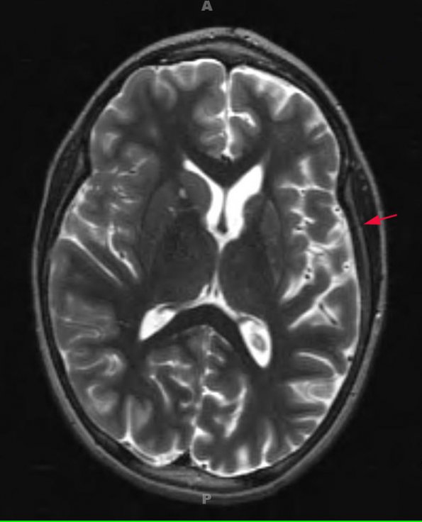 6A3 Rasmussen's Encephalitis (Case 6) T2 - Copy