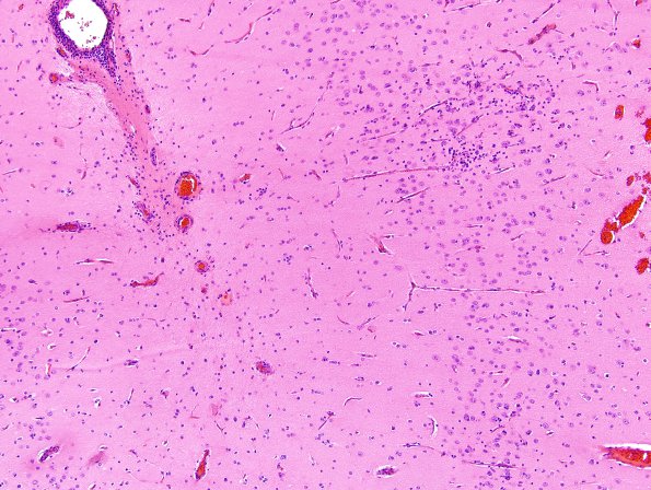 6B1 Rasmussen's Encephalitis (Case 6) H&E 5.