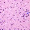 6B2 Rasmussen's Encephalitis (Case 6) H&E 1