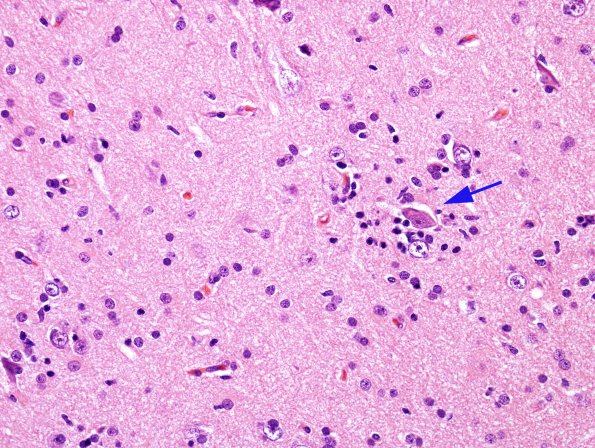 6B2 Rasmussen's Encephalitis (Case 6) H&E 1