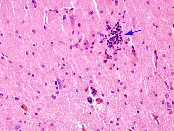 6B3 Rasmussen's Encephalitis (Case 6) H&E 4