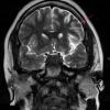 7A Rasmussen's Encephalitis (Case 7) T2 TSE COR 512 4 - Copy