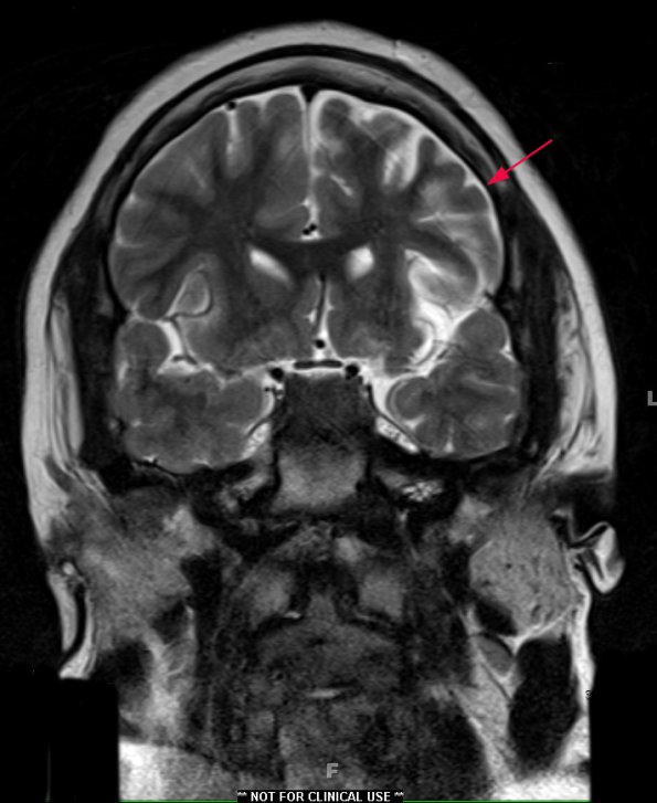 7A Rasmussen's Encephalitis (Case 7) T2 TSE COR 512 4 - Copy