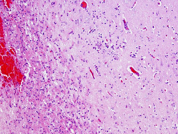 7B2 Rasmussen's Encephalitis (Case 7) H&E 7