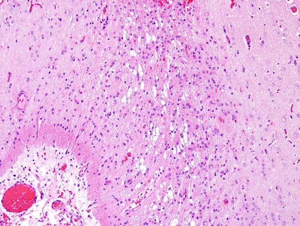 7B3 Rasmussen's Encephalitis (Case 7) H&E 8