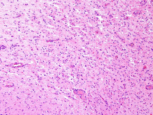 7B4 Rasmussen's Encephalitis (Case 7) H&E 13