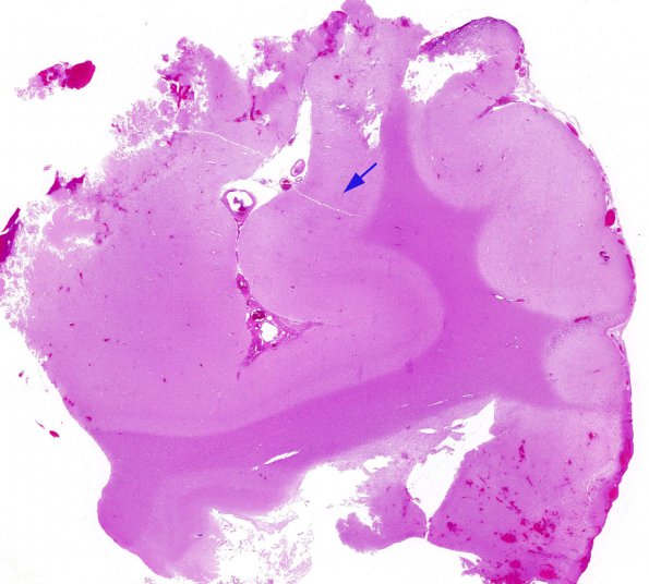 7C1 Rasmussen's Encephalitis (Case 7) 1 H&E whole mount