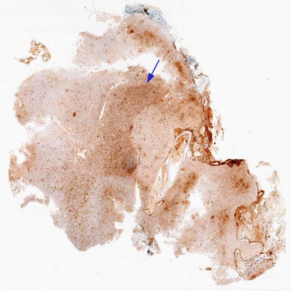 7C2 Rasmussen's Encephalitis (Case 7) 1 CD68 whole mount