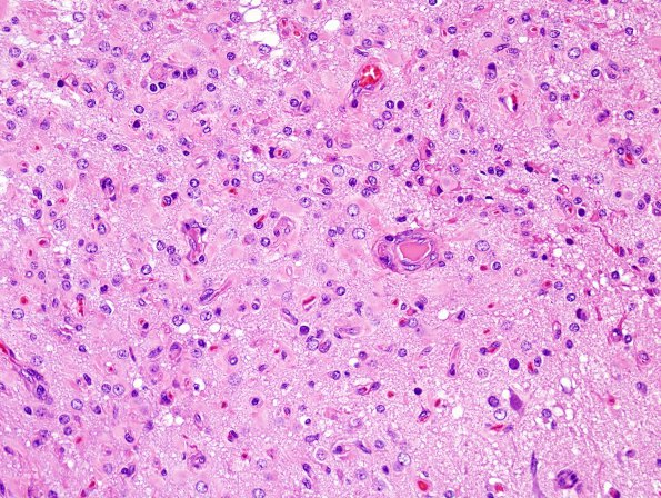 7D Rasmussen's Encephalitis (Case 7) H&E 14