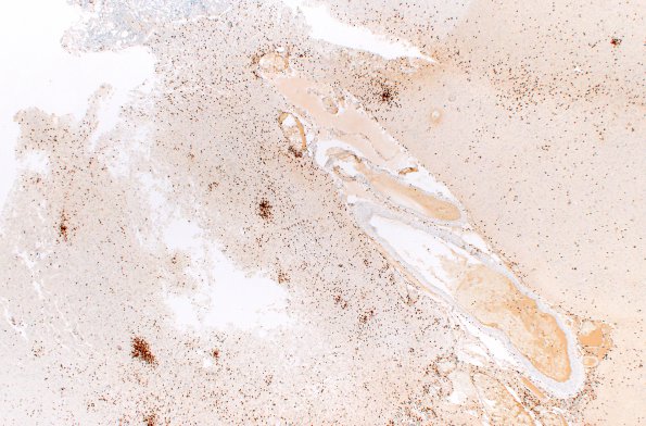 7E1 Rasmussen's (Case 7) CD3 2X