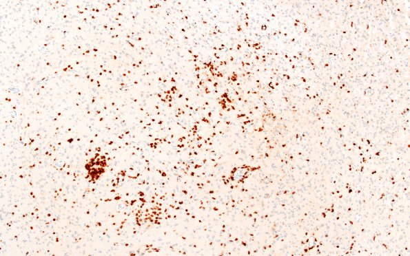 7E2 Rasmussen's (Case 7) CD3 20X 2