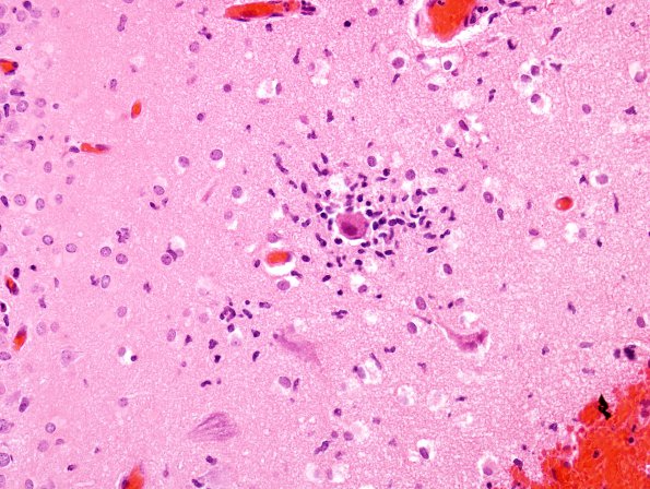 8A1 Rasmussen's Encephalitis (Case 8) H&E 1