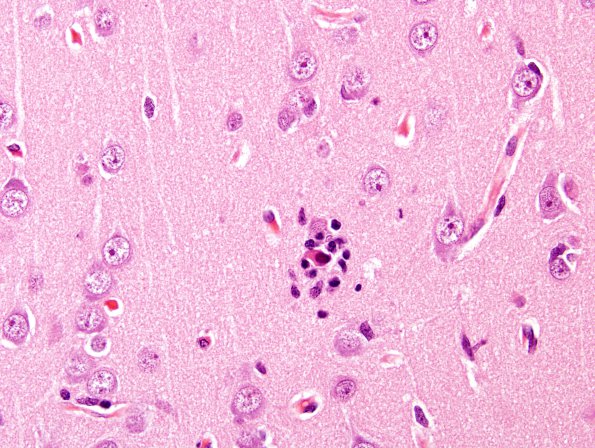 8A2 Rasmussen's Encephalitis (Case 8) H&E 8