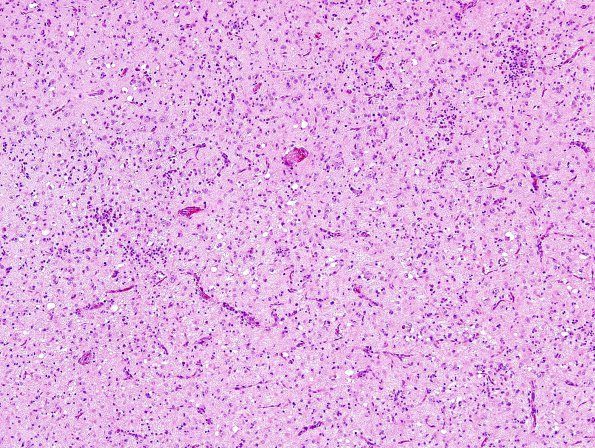 8A3 Rasmussen's Encephalitis (Case 8) H&E 5A