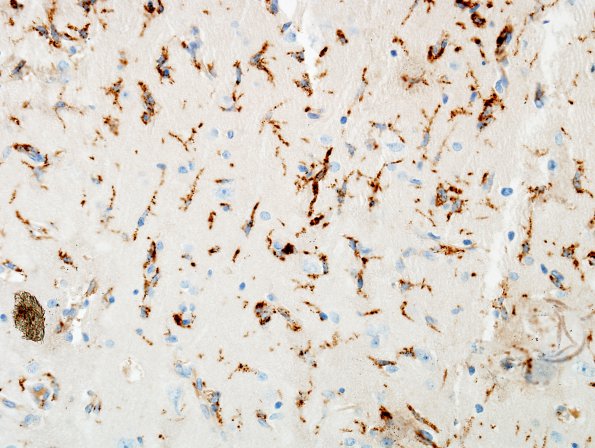 8B1 Rasmussen's Encephalitis (Case 8) CD68 1