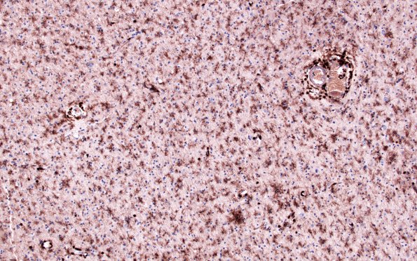 9B2 Rasmussen's (Case 9) LCA 6