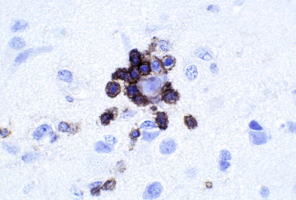 9B6 Rasmussen's Encephalitis (Case 9) LCA 2A