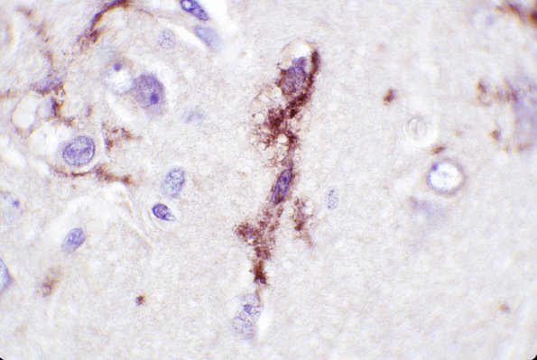 9B7 Rasmussen's Encephalitis (Case 9) LCA 3A