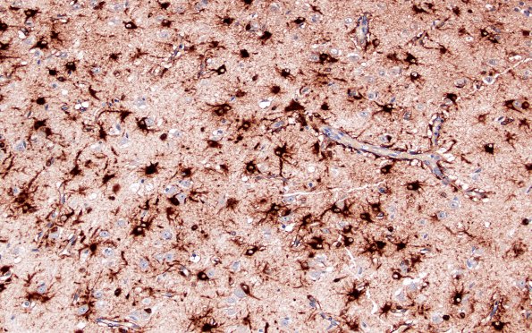 9C1 Rasmussen's (Case 9) S100 20X