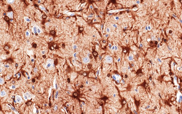 9C2 Rasmussen's (Case 9) S100 2