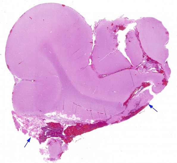 1A1 Cortical Resection 3 years prior (Case 1) 1 H&E 1