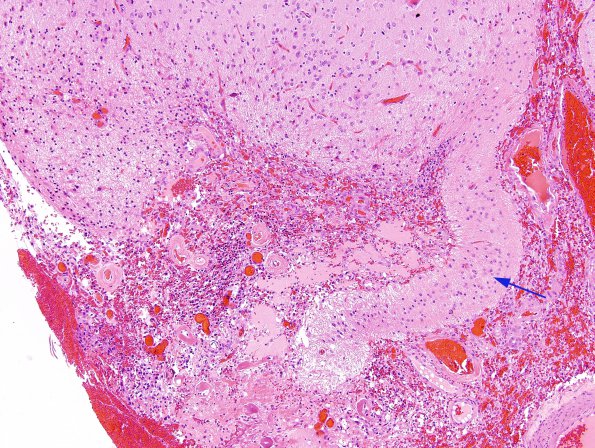 1A2 Cortical Resection 3 years prior (Case 1) H&E 2