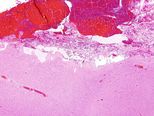 1A3 Cortical Resection 3 years prior (Case 1) H&E 3