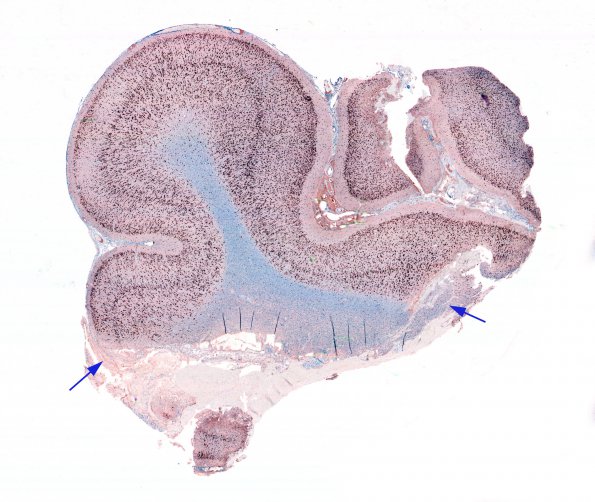 1B Cortical Resection 3 years prior (Case 1) 1 NeuN