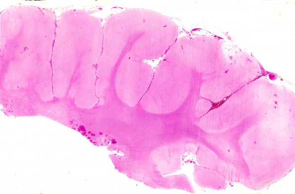 1B1 Ulegyria (Case 1) H&E whole mount 1