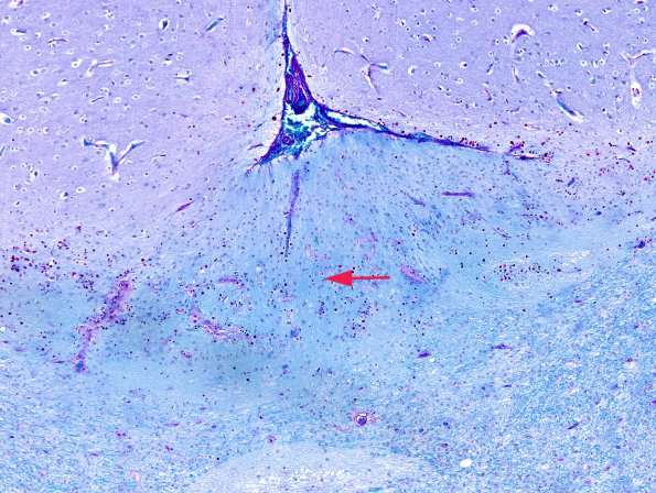 1C1 Ulegyria (Case 1) LFB-PAS 2