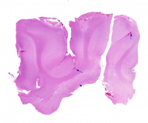 2A1 Infarct, neonatal Sz (Case 2) H&E whole mount 2