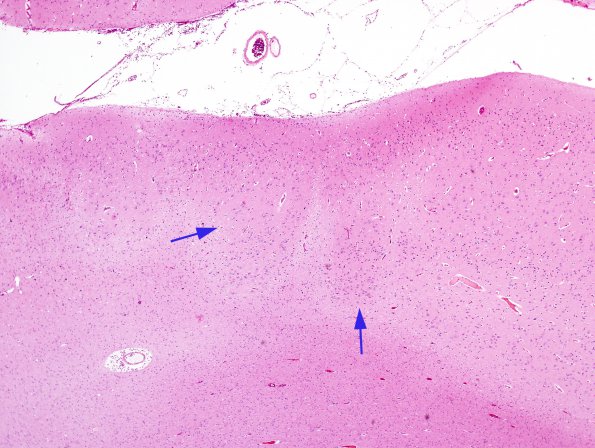 2A2 Infarct, neonatal Sz (Case 2) H&E 5