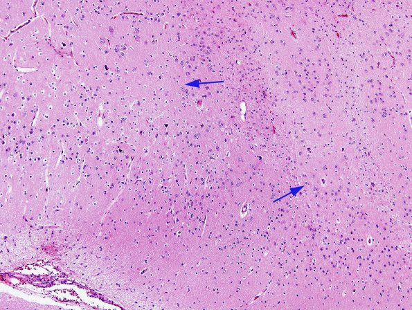 2A3 Infarct, neonatal Sz (Case 2) H&E 7