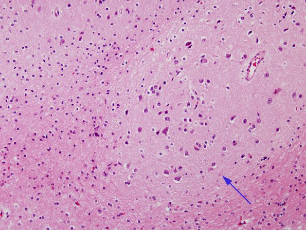 2A4 Infarct, neonatal Sz (Case 2) H&E 2