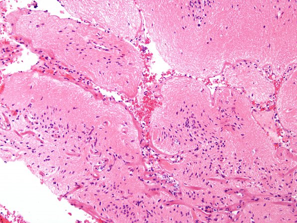 2A6 Infarct, neonatal Sz (Case 2) H&E 3