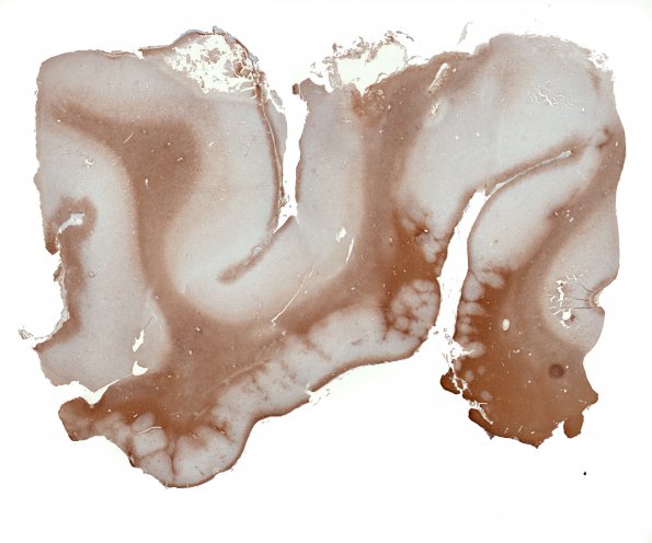 2B1 Infarct, neonatal Sz (Case 2) GFAP whole mount 2