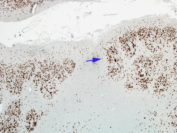 2C4 Infarct, neonatal Sz (Case 2) NeuN 1