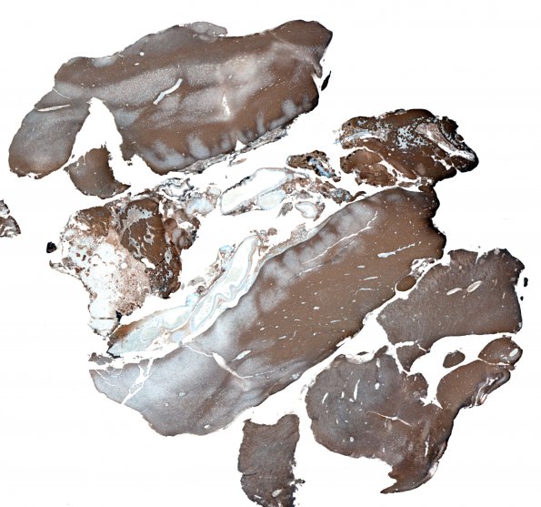 2C5 Infarct, neonatal Sz (Case 2) GFAP whole mount