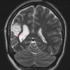 3A1 Epilepsy, MCA infarct, ulegyria (Case 3)  T2-TSE-COR 512-3mm no C 2 - Copy